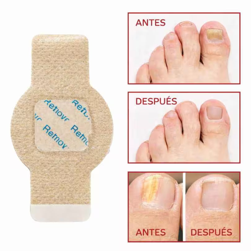 PARCHES ANTIHONGOS PARA UÑAS